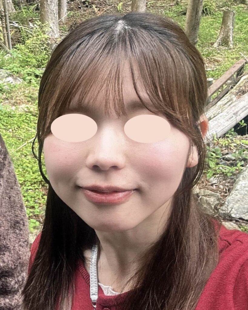 かわいさそのまま、すっきり小顔へ BEFORE写真