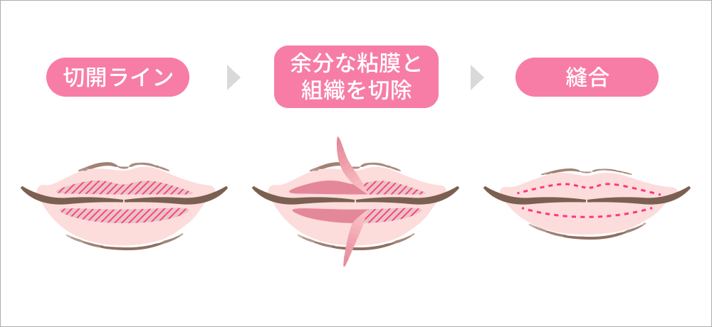口唇縮小術のプロセス
