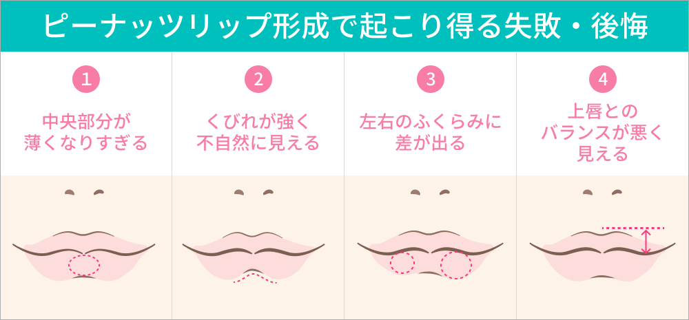 ピーナッツ・リップ（口元）形成術の失敗と後悔