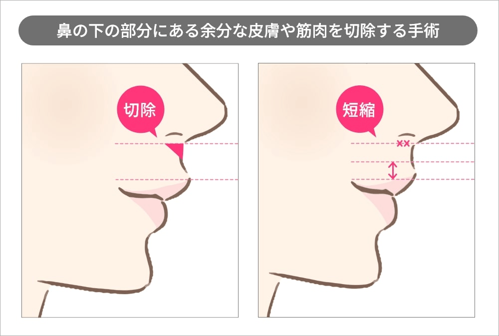 リップリフト手術