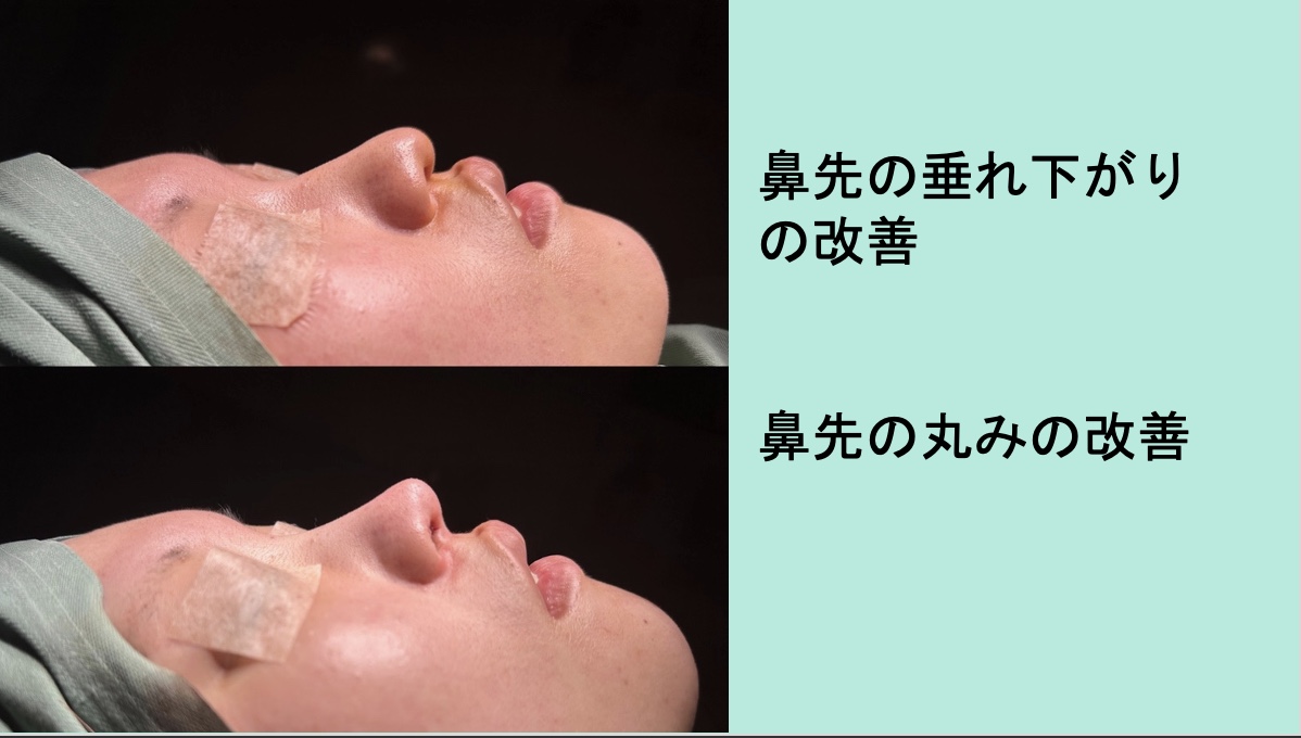『鼻柱に一切傷のできないクローズ法でしっかり変化のある鼻整形を』の画像