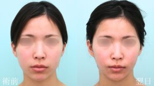 『『余白』を減らし垢抜けへ。脂肪吸引で本来の美しさを削り出す。』の画像