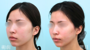 『『余白』を減らし垢抜けへ。脂肪吸引で本来の美しさを削り出す。』の画像