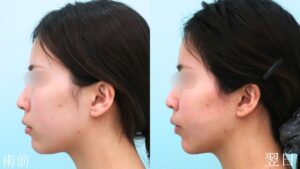 『『余白』を減らし垢抜けへ。脂肪吸引で本来の美しさを削り出す。』の画像