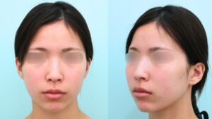 『『余白』を減らし垢抜けへ。脂肪吸引で本来の美しさを削り出す。』の画像