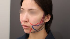 『『余白』を減らし垢抜けへ。脂肪吸引で本来の美しさを削り出す。』の画像