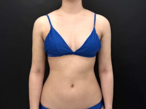 『【1ヶ月で別人級の後ろ姿に】二の腕脂肪吸引において大量の吸引を可能にする8工程のこだわり』の画像