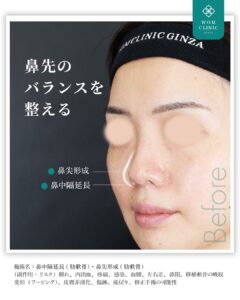 『鼻中隔延長と鼻尖形成でナチュラルにコンプレックス解消！整形感を極限まで無くしてバレない鼻整形』の画像