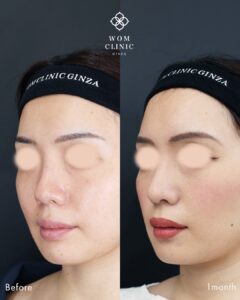 『鼻中隔延長と鼻尖形成でナチュラルにコンプレックス解消！整形感を極限まで無くしてバレない鼻整形』の画像