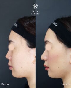 『鼻中隔延長と鼻尖形成でナチュラルにコンプレックス解消！整形感を極限まで無くしてバレない鼻整形』の画像