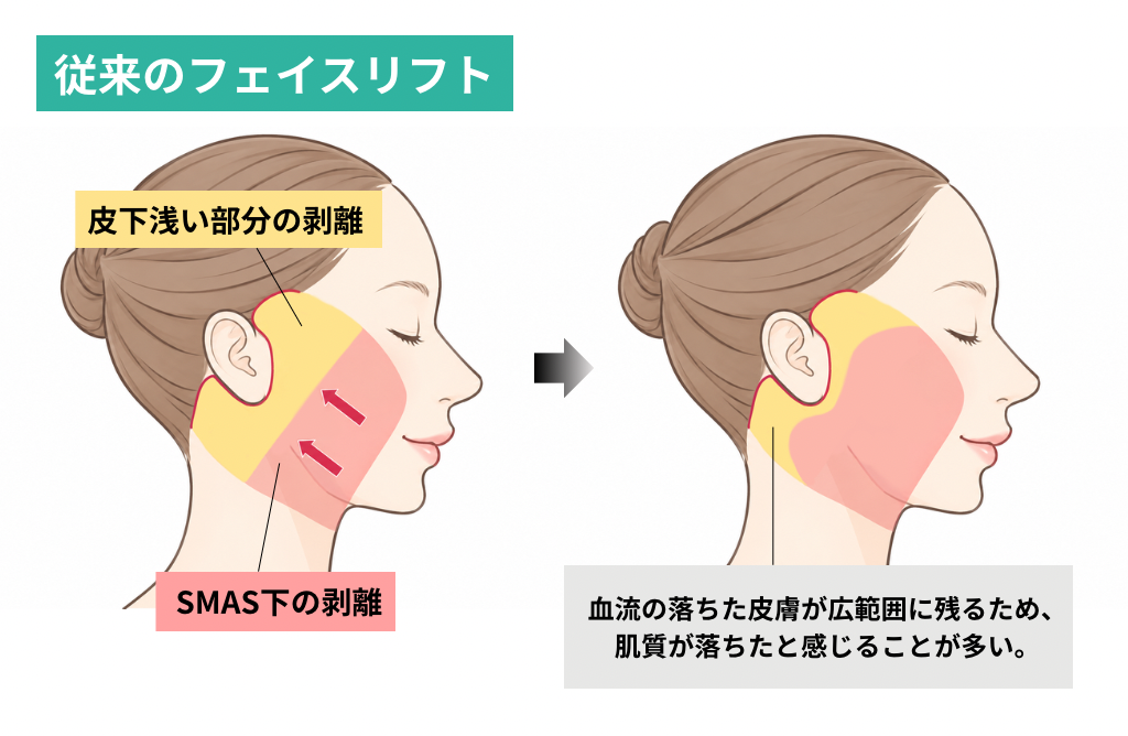 フェイスリフト