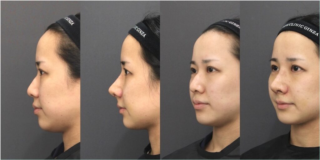『わし鼻を削り、肋軟骨で理想のバランスへ – 中顔面形成で立体感をプラス』の画像