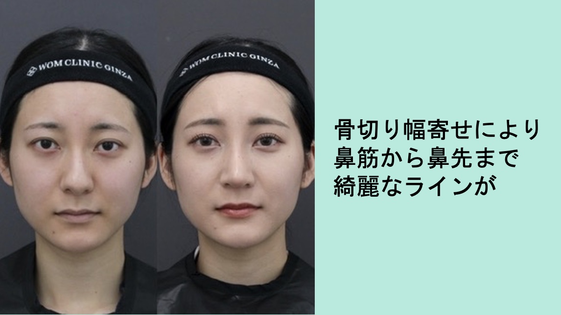 『初めての鼻整形 – わし鼻&鼻筋を整え、女性らしい印象へ』の画像