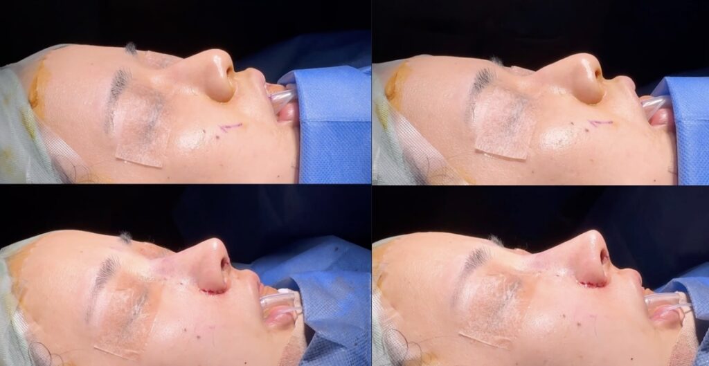 『わし鼻を削り、肋軟骨で理想のバランスへ – 中顔面形成で立体感をプラス』の画像