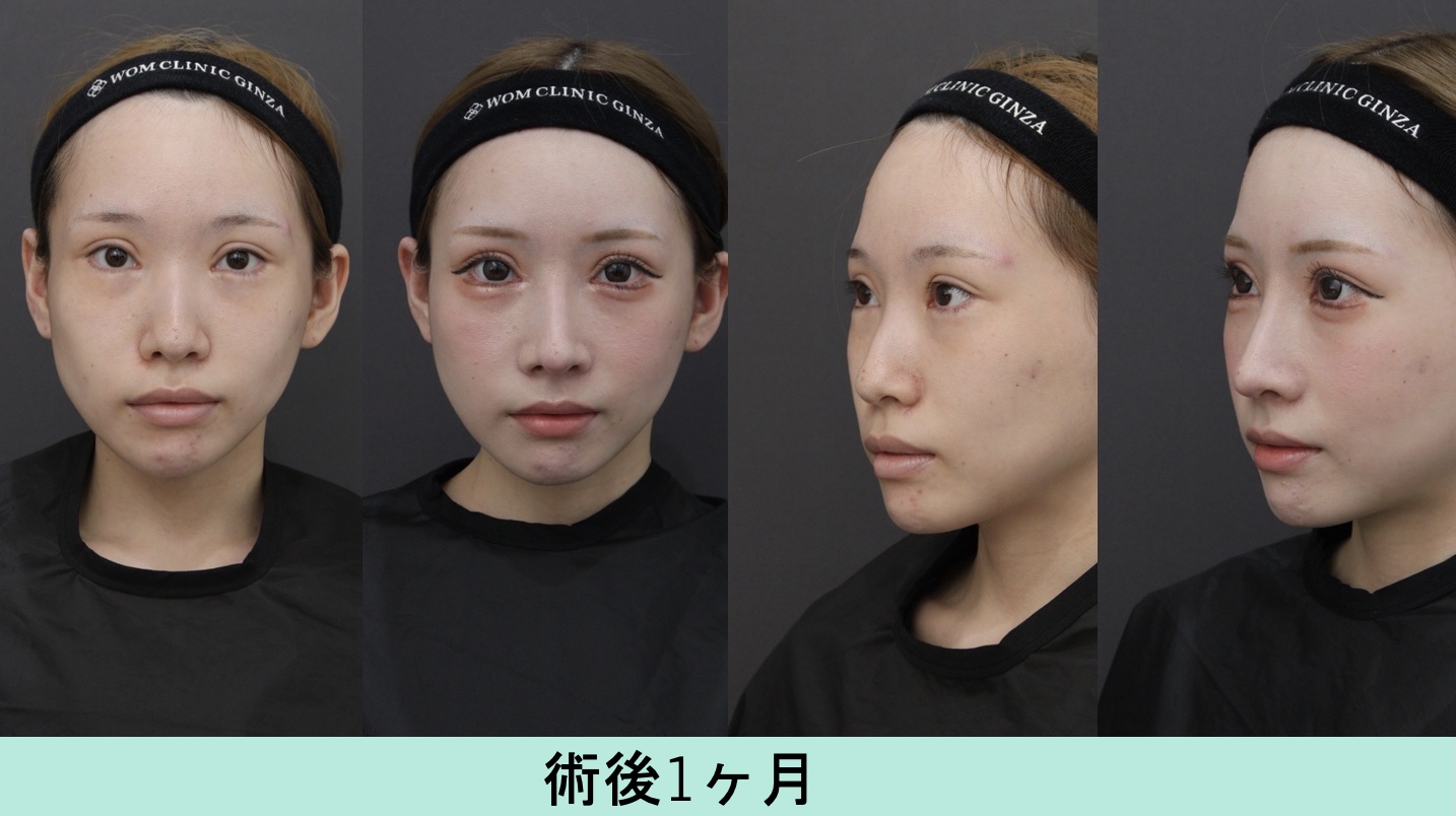 『あなたにとってバランスのいい鼻とは?好みとバランスの両立した鼻を肋軟骨で』の画像