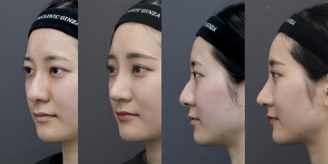 『初めての鼻整形 – わし鼻&鼻筋を整え、女性らしい印象へ』の画像