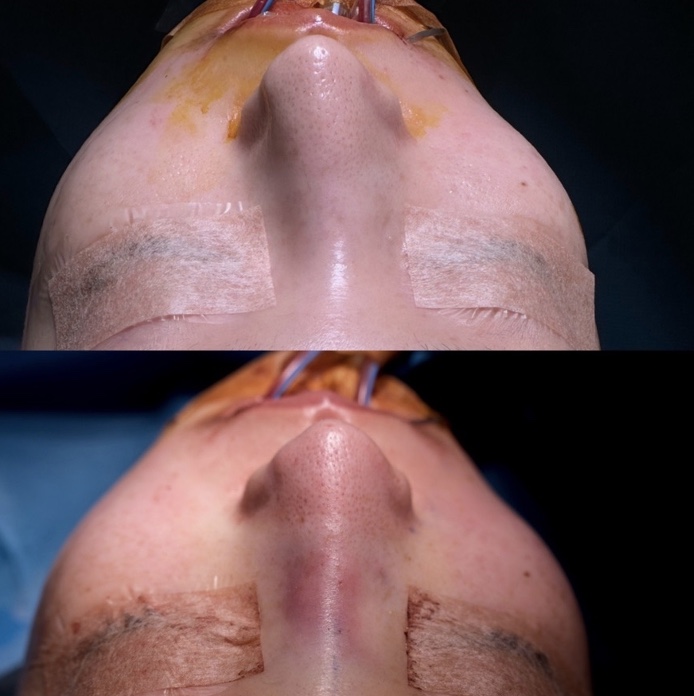 『鼻修正 × 輪郭骨切りを同時に行い、顔全体のバランスを根本から整える』の画像