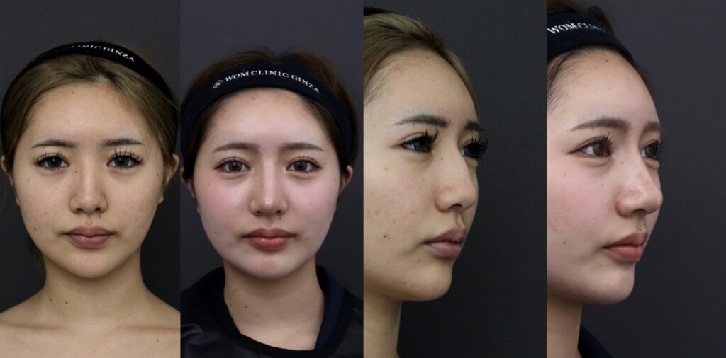 『高さを出しながらハンプを消す ― アジア人に最適化した世界基準のアプローチ』の画像