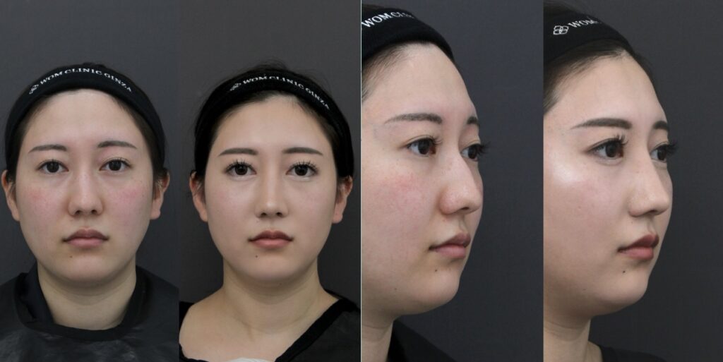 『【ReductionとAugmentationの違い】 西洋のわし鼻治療と、アジア人に適したPreservationという選択』の画像