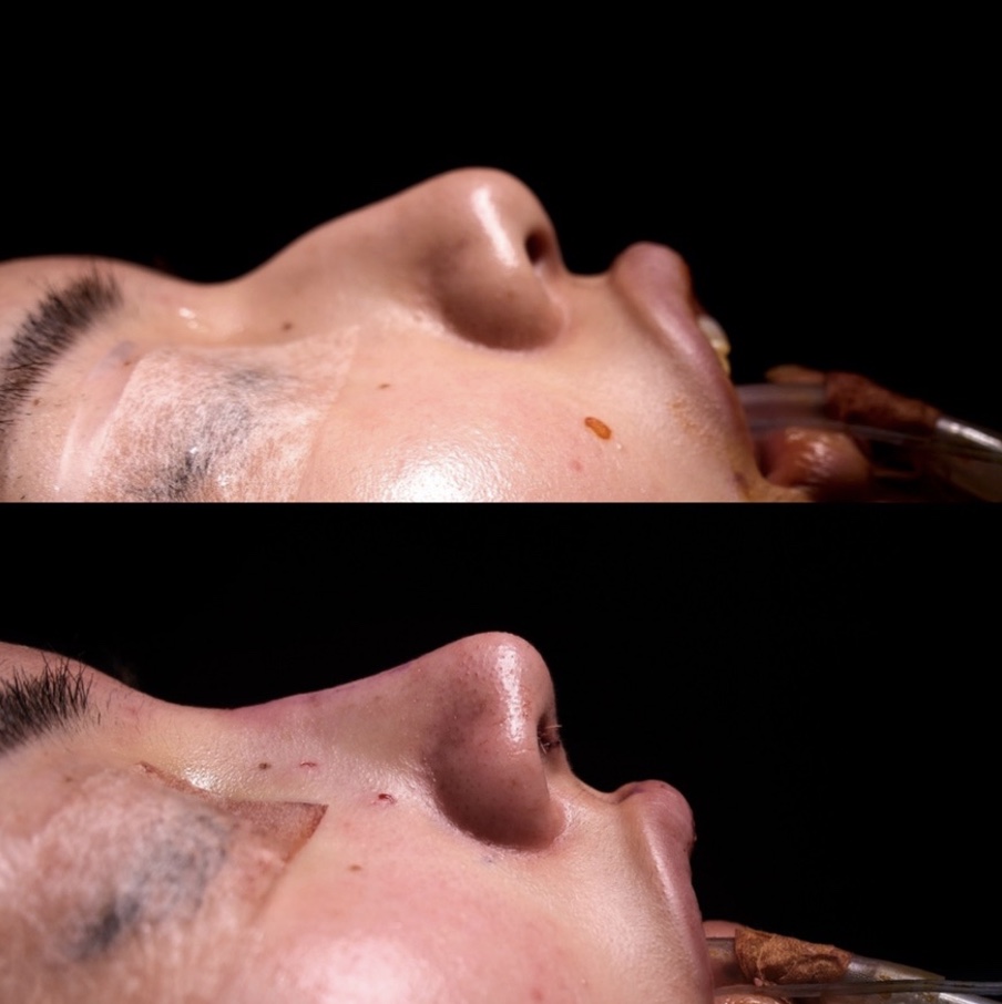 『高さを出しながらハンプを消す ― アジア人に最適化した世界基準のアプローチ』の画像