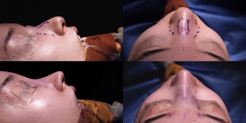 『中顔面の立体感を整え、口元の突出感まで改善した初回鼻整形』の画像