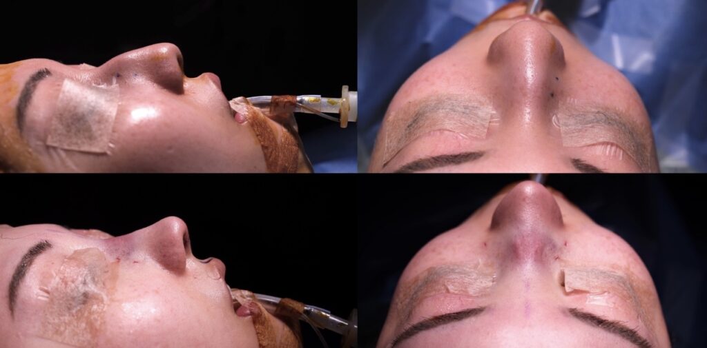 『【ReductionとAugmentationの違い】 西洋のわし鼻治療と、アジア人に適したPreservationという選択』の画像