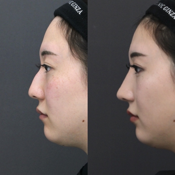 『【ReductionとAugmentationの違い】 西洋のわし鼻治療と、アジア人に適したPreservationという選択』の画像