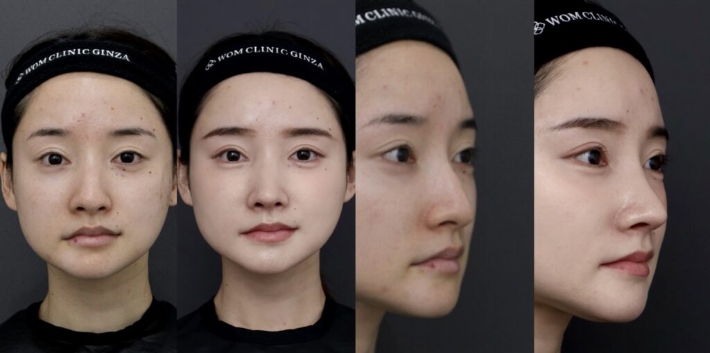 『中顔面の立体感を整え、口元の突出感まで改善した初回鼻整形』の画像
