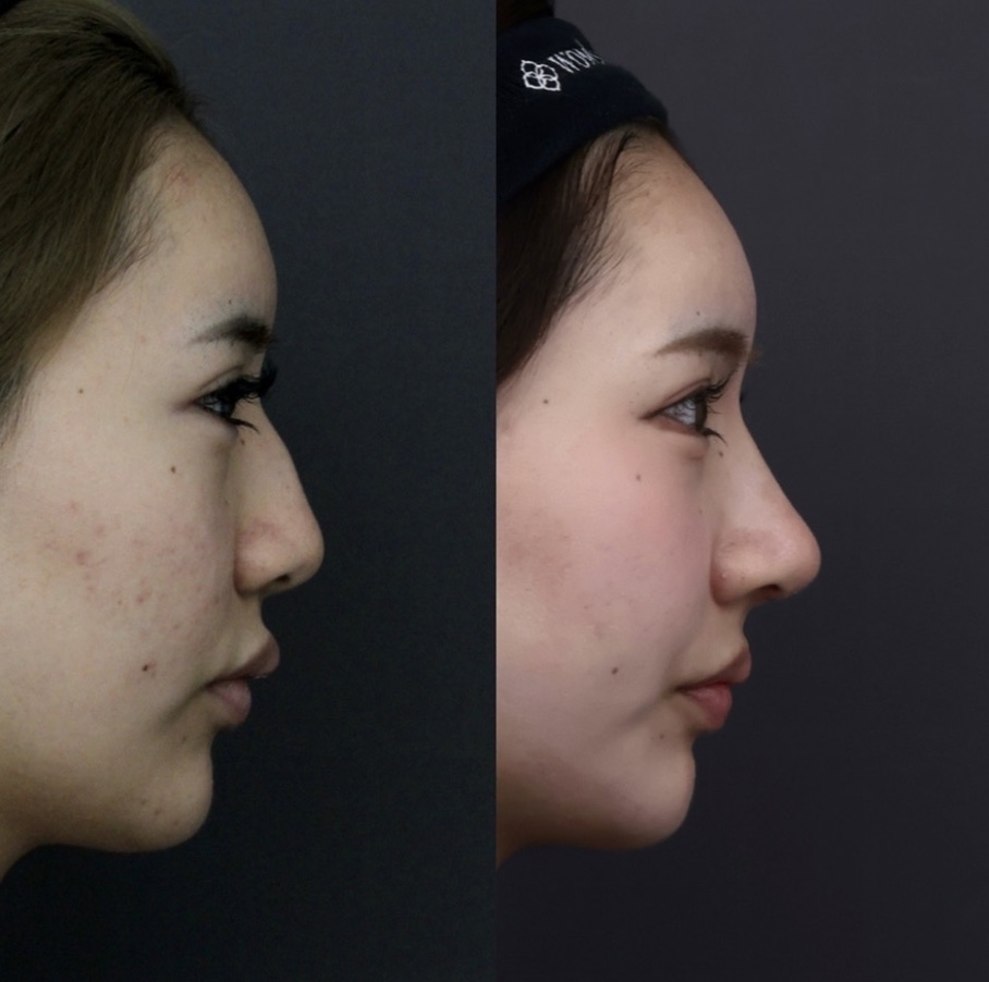 『高さを出しながらハンプを消す ― アジア人に最適化した世界基準のアプローチ』の画像