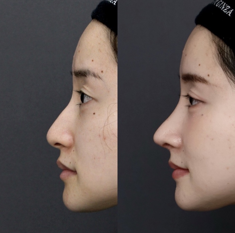 『中顔面の立体感を整え、口元の突出感まで改善した初回鼻整形』の画像