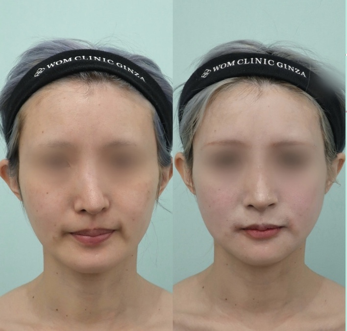 『鼻修正 × 輪郭骨切りを同時に行い、顔全体のバランスを根本から整える』の画像