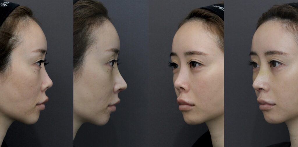 『重度修正症例:韓国での手術後に拘縮が起きた鼻の再建』の画像