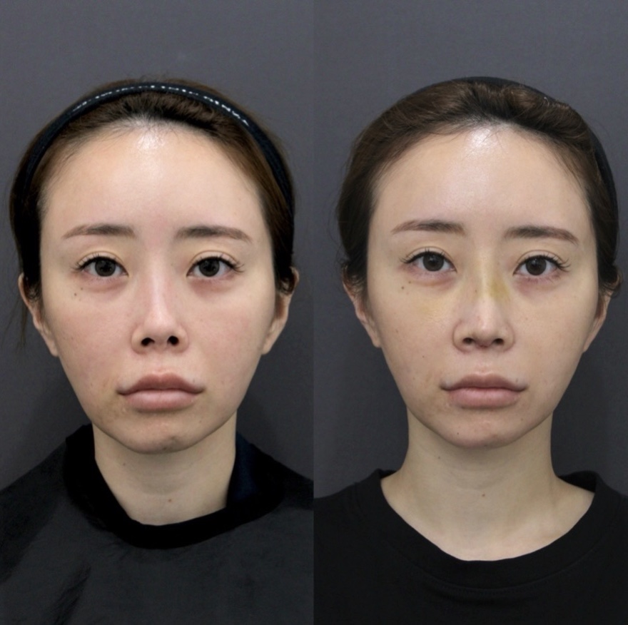 『重度修正症例:韓国での手術後に拘縮が起きた鼻の再建』の画像