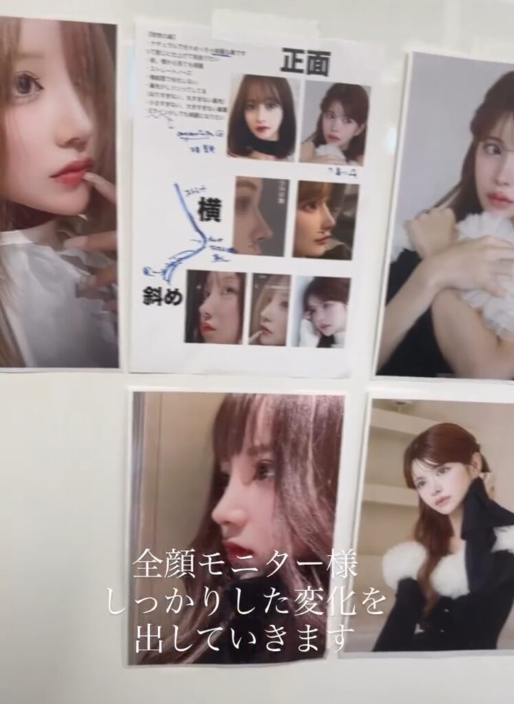 『厚い皮膚・団子鼻でもここまで変わる ― 中顔面を考慮した鼻整形』の画像