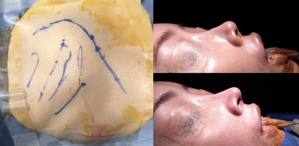 『重度修正症例:韓国での手術後に拘縮が起きた鼻の再建』の画像