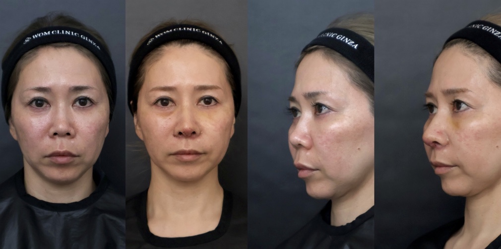 鼻中隔延長(肋軟骨) 鼻尖形成 猫手術 人中短縮flap
