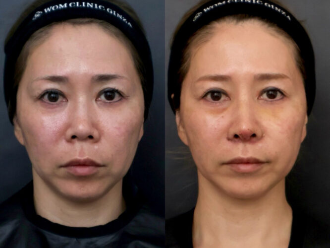 鼻中隔延長(肋軟骨)　鼻尖形成　猫手術　人中短縮flap