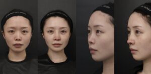 鼻整形 before after