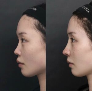 鼻整形 before after